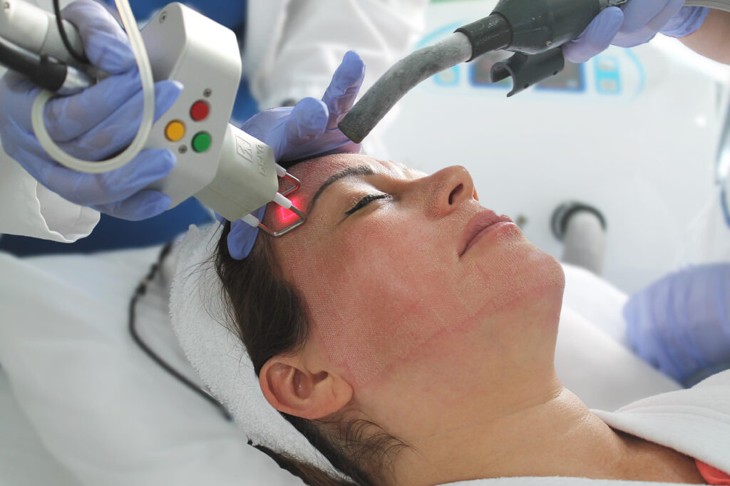 Aplicacion de laser co2 fraccionado 2 / Medical HS